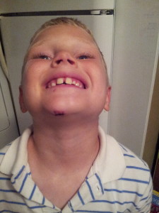 Showing off his battle wound - 3 stitches